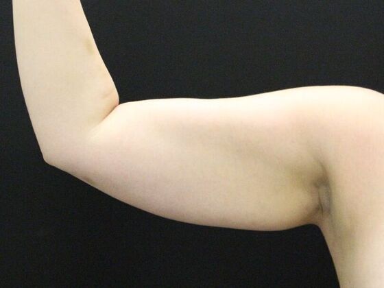 Arm Lift & Reduction: Case 6 - Before