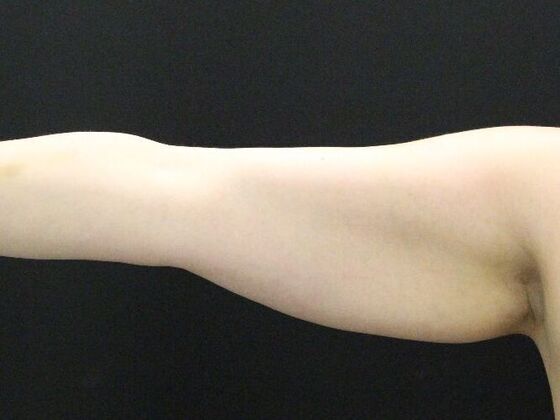 Arm Lift & Reduction Case 6 - Before