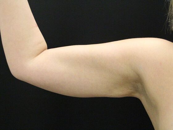 Arm Lift & Reduction: Case 6 - After