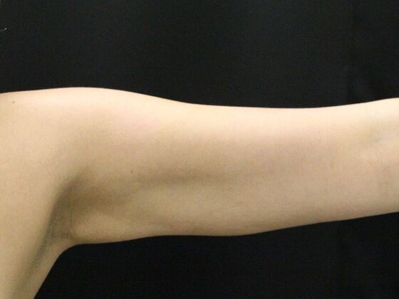 Arm Lift & Reduction: Case 6 - After