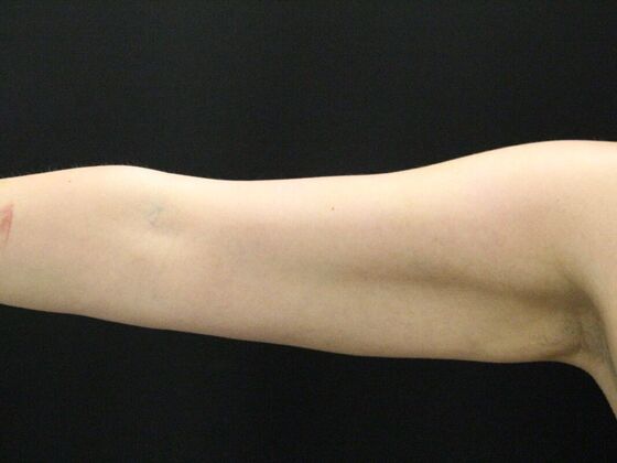 Arm Lift & Reduction Case 6 - After