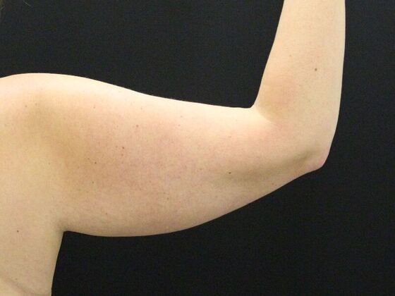 Arm Lift & Reduction: Case 7 - Before