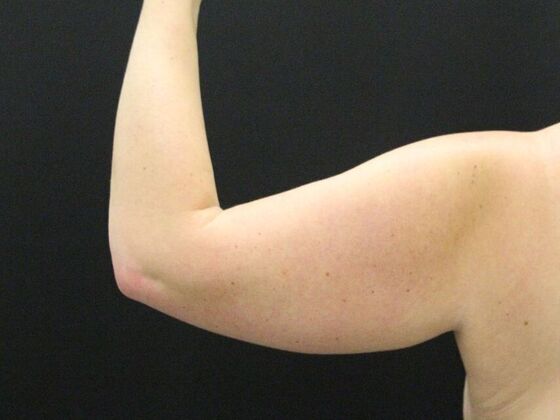 Arm Lift & Reduction: Case 7 - Before