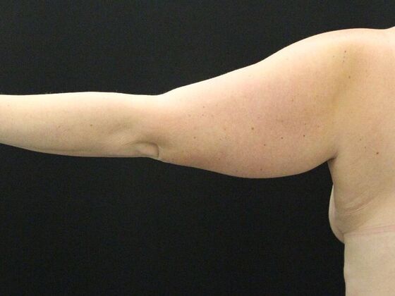 Arm Lift & Reduction: Case 7 - Before