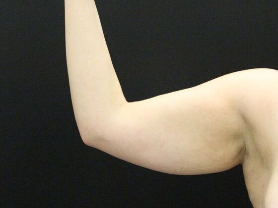 Arm Lift & Reduction: Case 7 - Before