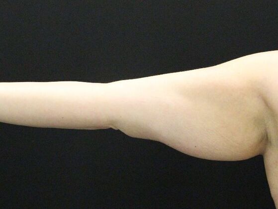 Arm Lift & Reduction Case 7 - Before