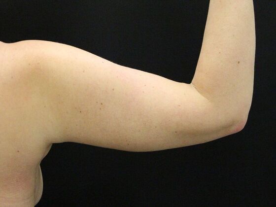Arm Lift & Reduction: Case 7 - After