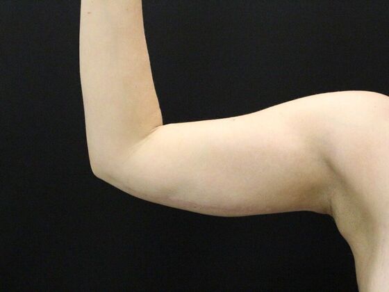 Arm Lift & Reduction: Case 7 - After