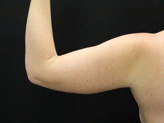 Arm Lift & Reduction: Case 7 - After