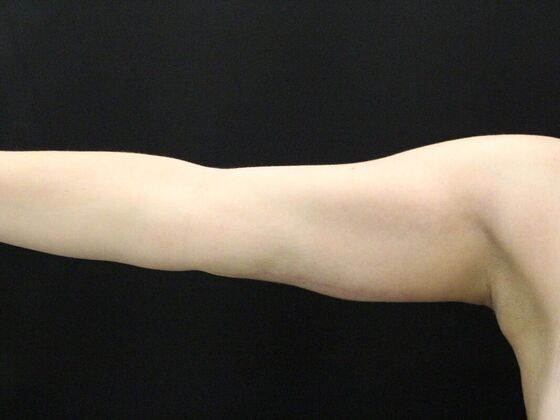 Arm Lift & Reduction Case 7 - After