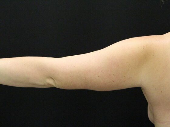 Arm Lift & Reduction: Case 7 - After