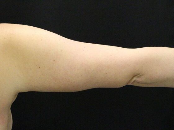 Arm Lift & Reduction: Case 7 - After