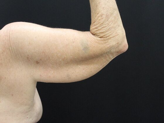 Arm Lift & Reduction Case 8 - Before