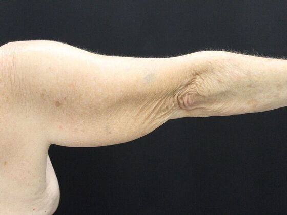 Arm Lift & Reduction: Case 8 - Before