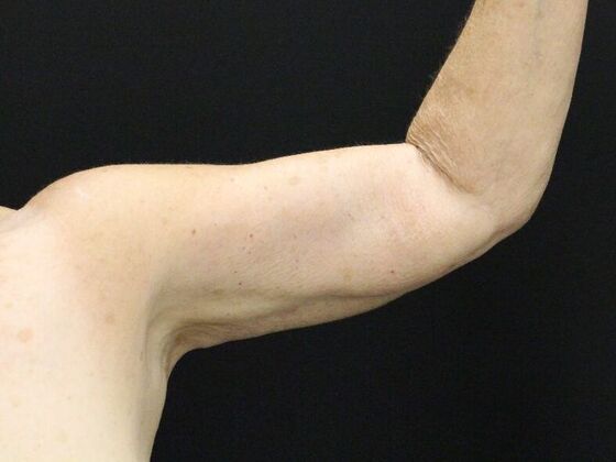 Arm Lift & Reduction: Case 8 - After