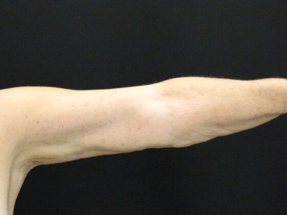 Arm Lift & Reduction: Case 8 - After