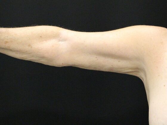 Arm Lift & Reduction: Case 8 - After