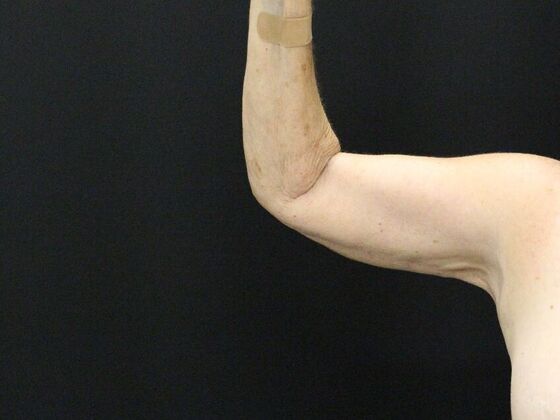 Arm Lift & Reduction: Case 8 - After