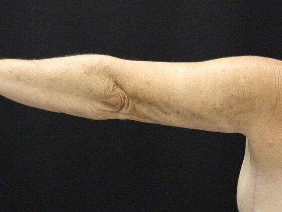 Arm Lift & Reduction: Case 8 - After