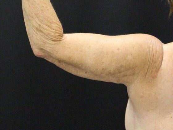 Arm Lift & Reduction: Case 8 - After