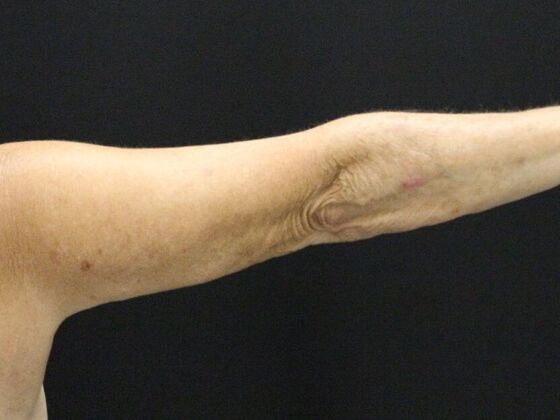 Arm Lift & Reduction: Case 8 - After