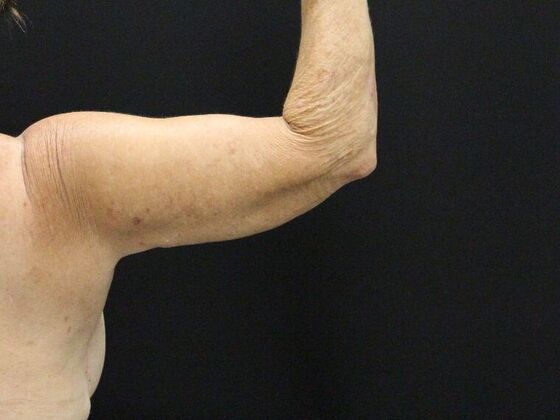 Arm Lift & Reduction Case 8 - After