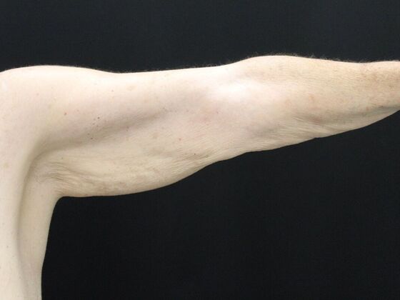 Arm Lift & Reduction: Case 8 - Before