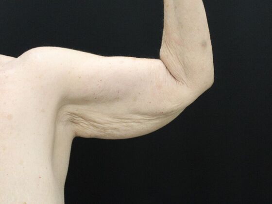 Arm Lift & Reduction: Case 8 - Before