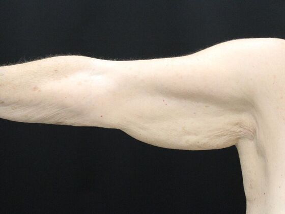 Arm Lift & Reduction: Case 8 - Before