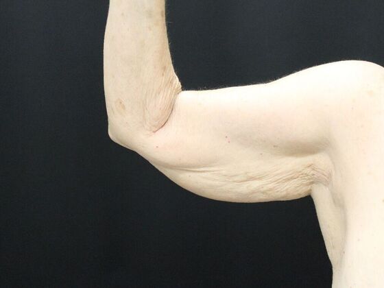 Arm Lift & Reduction: Case 8 - Before