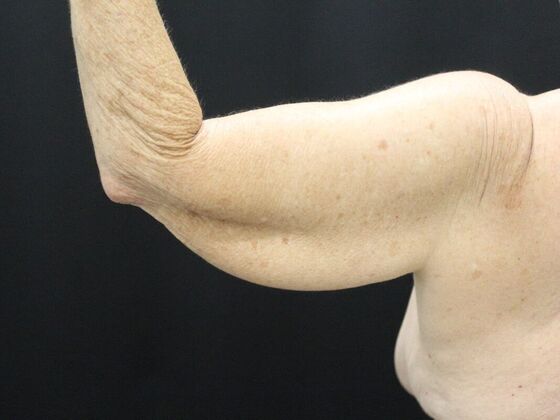 Arm Lift & Reduction: Case 8 - Before