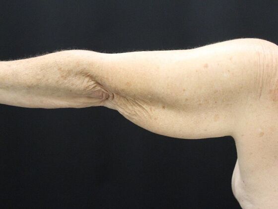 Arm Lift & Reduction: Case 8 - Before