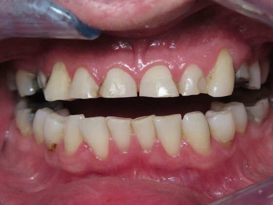Full Mouth Rehabilitation Case 1 - Before