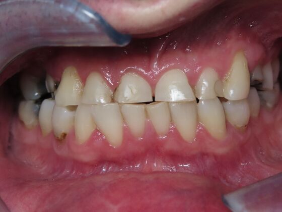 Full Mouth Rehabilitation: Case 1 - Before