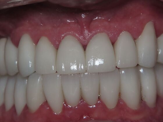 Full Mouth Rehabilitation: Case 1 - After