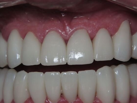 Full Mouth Rehabilitation Case 1 - After