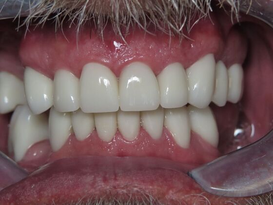 Full Mouth Rehabilitation Case 2 - After