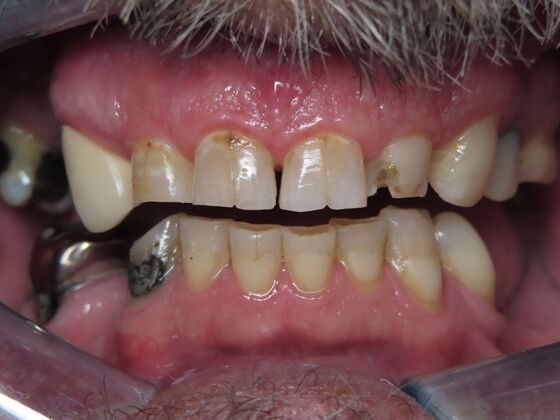 Full Mouth Rehabilitation Case 2 - Before