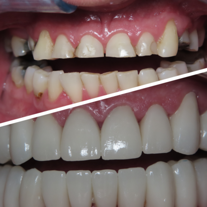Full Mouth Rehabilitation Cases