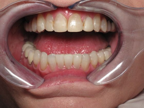 Veneers Case 2 - Before