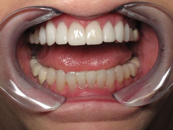 Veneers Case 2 - After