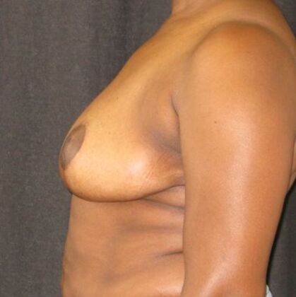 Breast Reduction: Case 11 - After