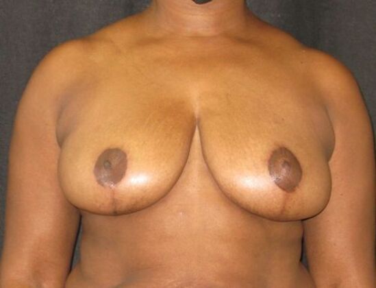 Breast Reduction Case 11 - After