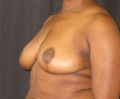 Breast Reduction: Case 11 - After