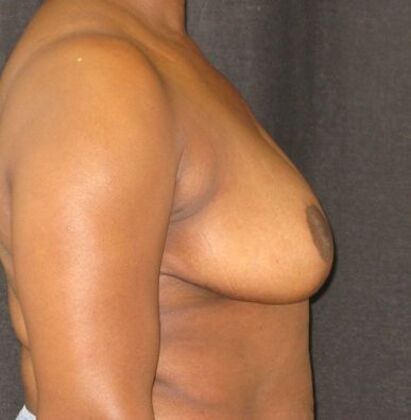 Breast Reduction: Case 11 - After