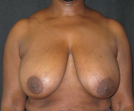 Breast Reduction Case 11 - Before