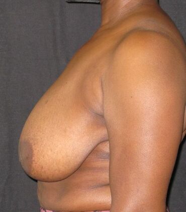 Breast Reduction: Case 11 - Before