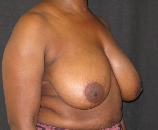 Breast Reduction: Case 11 - Before