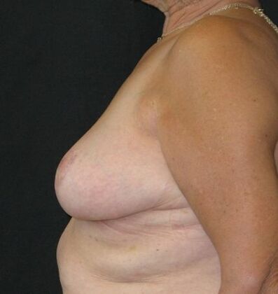 Breast Reduction: Case 12 - After