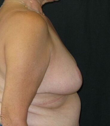 Breast Reduction: Case 12 - After